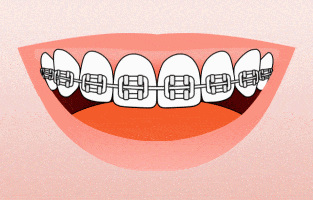 Smiling mouth displaying metal braces on upper teeth against pink background.