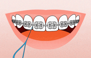 Illustration of teeth with metal braces and blue floss, demonstrating orthodontic dental care.