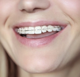 Close-up of person's smile displaying metal braces on upper teeth
