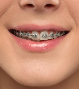 Close-up of smile showing metal braces on upper teeth with pink lip gloss applied.
