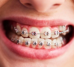 Close-up of smile displaying metal braces with colored bands on upper and lower teeth.