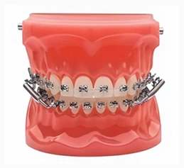 Dental model displaying metal braces on upper and lower teeth for orthodontic treatment demonstration.