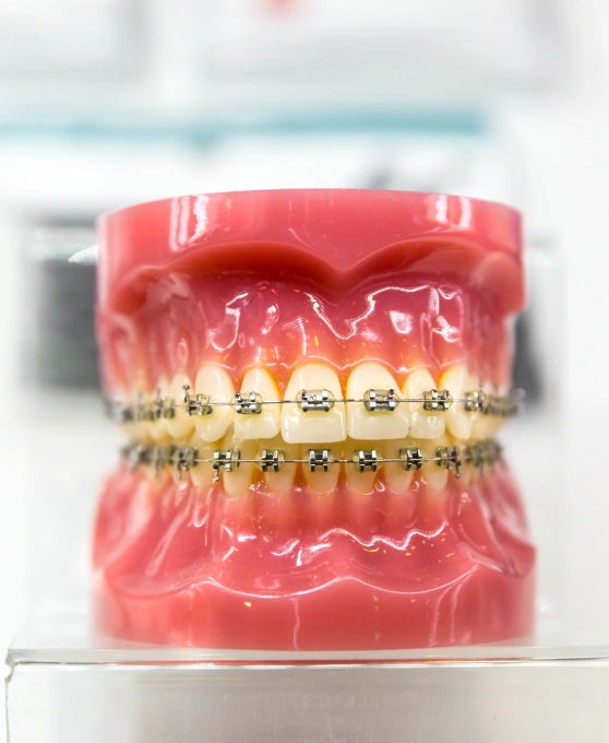 Orthodontic model displaying metal braces on upper and lower teeth with pink gums.