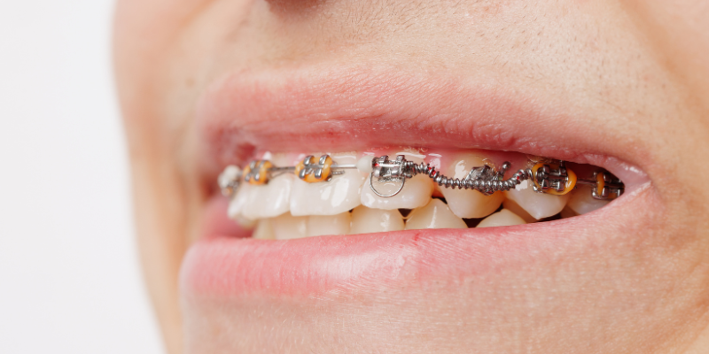 Orthodontist in Issaquah