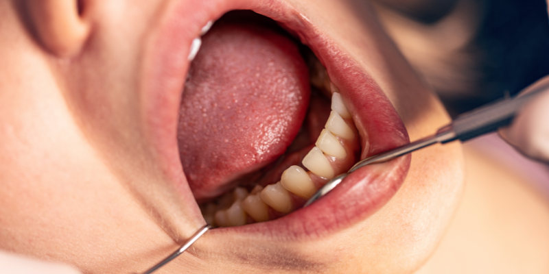 orthodontist near me in Issaquah