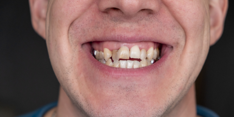 invisalign near me in Issaquah