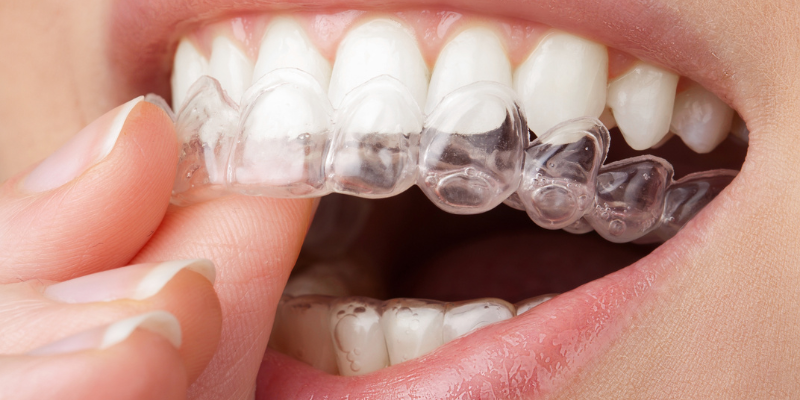 invisalign near me in Issaquah
