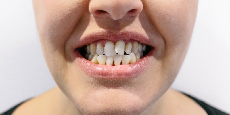 orthodontist near me in Issaquah
