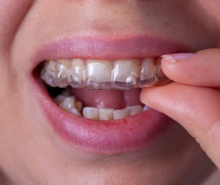 Patient inserting a clear aligner tray onto upper teeth