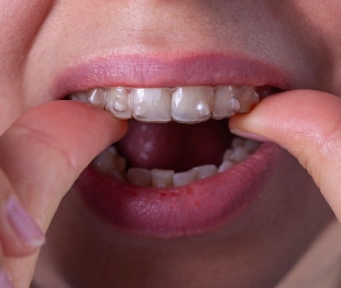 Patient removing a clear aligner tray from upper teeth