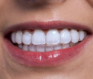 Patient smiling with straight teeth after clear aligner treatment