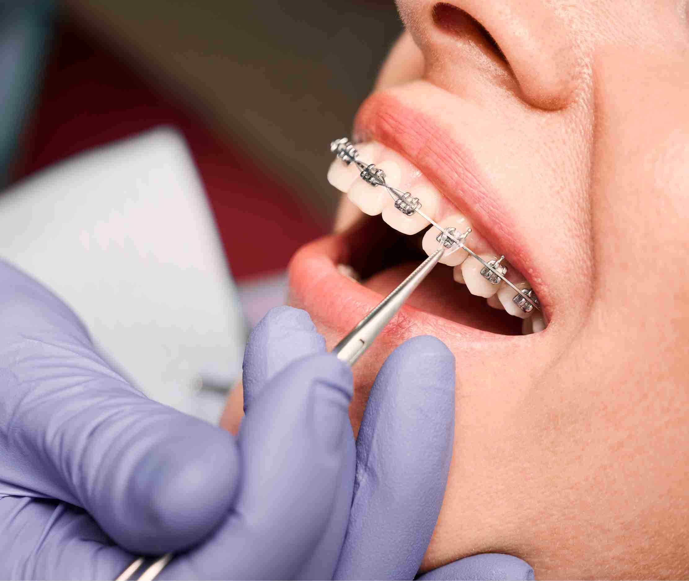 Orthodontist adjusting metal braces on patient's teeth during dental treatment.